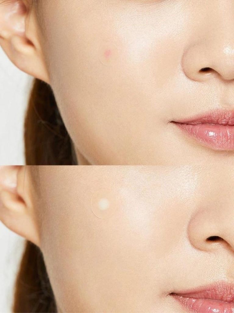 COSRX Acne Pimple Patch (24 Patches)